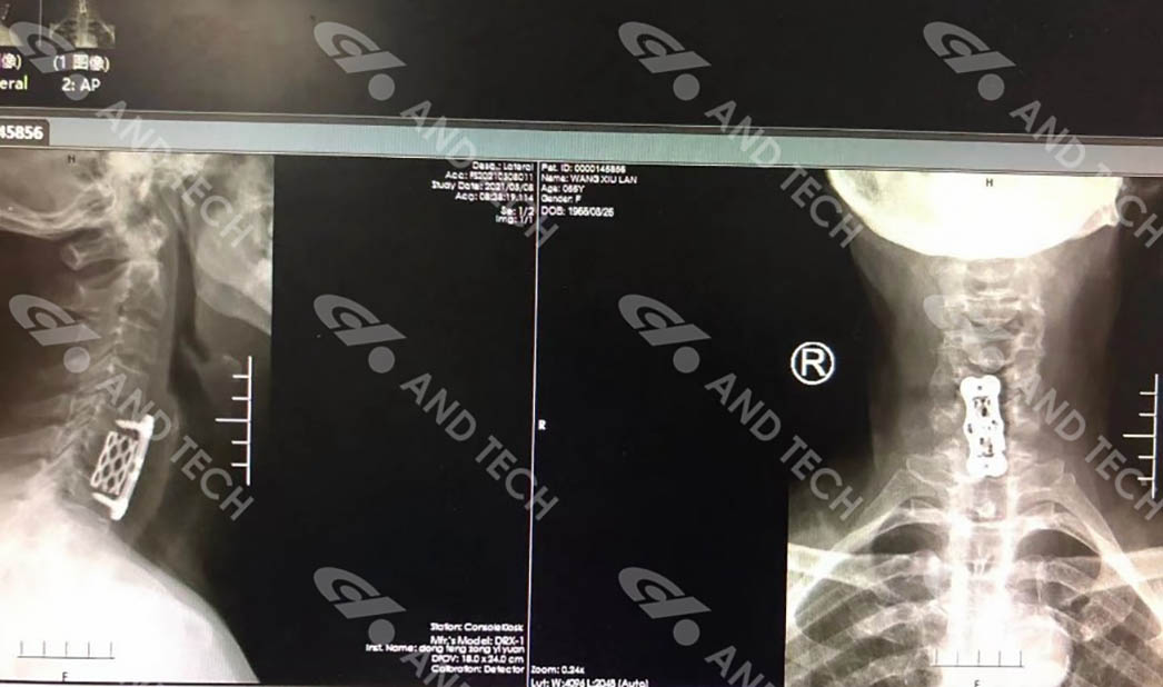 Causa Study-Anterior chirurgica cervicali feliciter peracta est