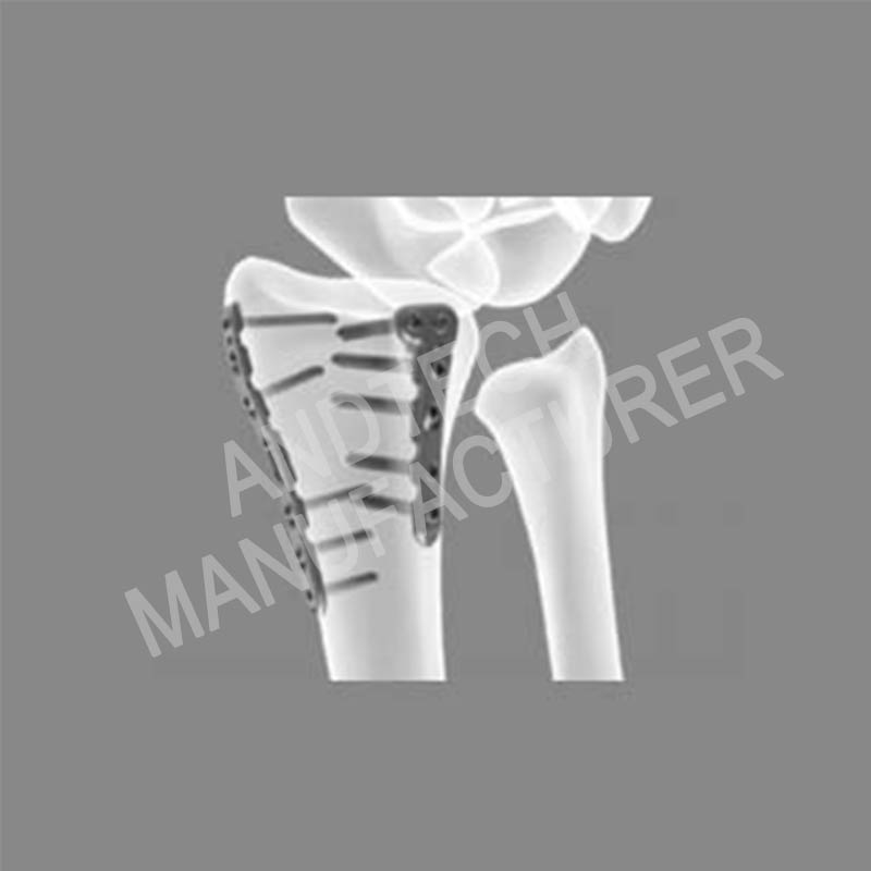 Distal-back-radius-L-type-locking-platesplates-2-holes03