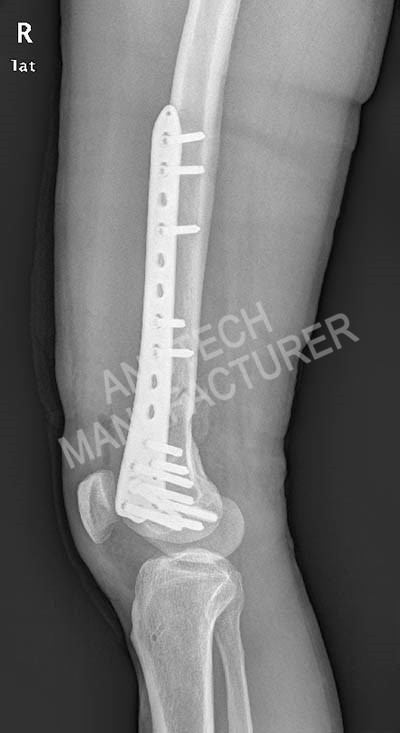 Distal-femur 2