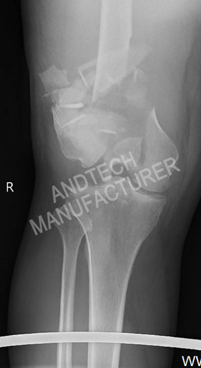 Distale femur3