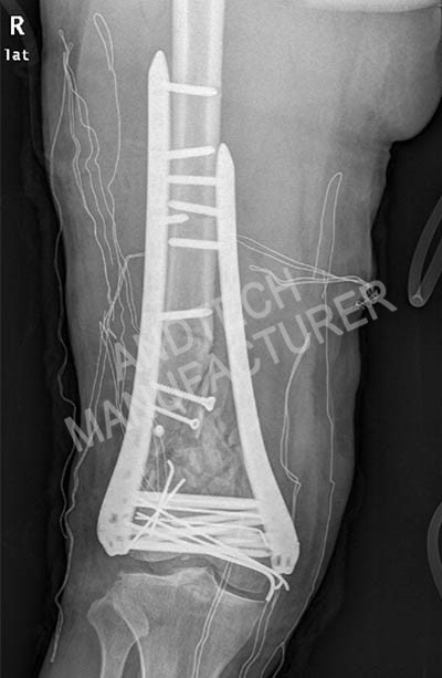 Distálny femur 4