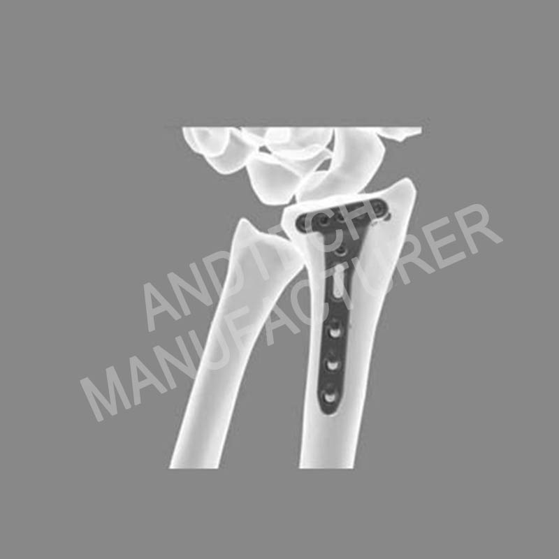 Distal-radius-Volar-oblique-T-locking-Platehead-5-holes01