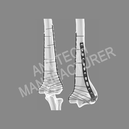 Elbow Joint Locking Plate System4