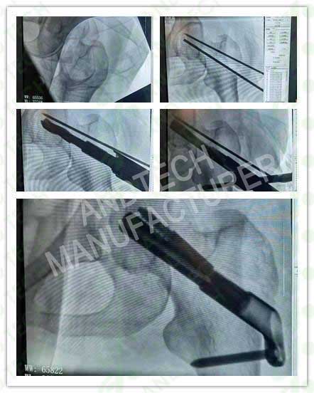 FNS-Femoral-Gât-Sistem-case