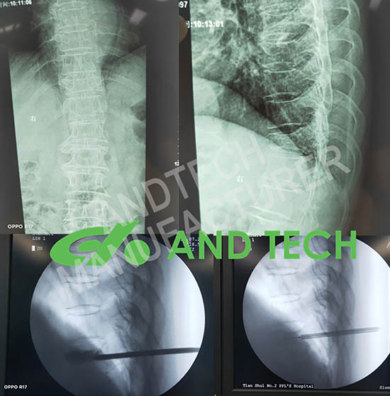 Kyphoplasty Cov cuab yeej System nrog ntau yam sib xyaw ua ke CASE