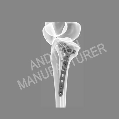 Proximal Tibia Medial Locking Plate ll photo1