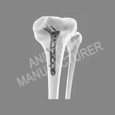 Proximal Tibia Posterior Medial Locking Plate II ဓာတ်ပုံ ၁