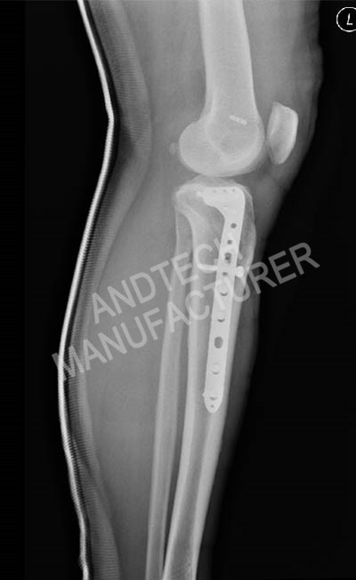 Proximal-Tibia 1