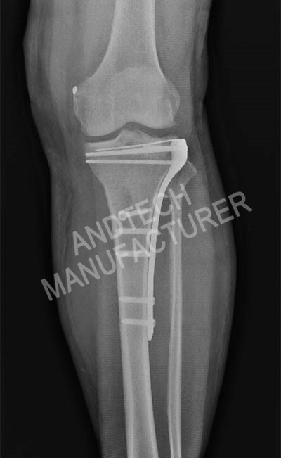 Proximal-Tibia 2