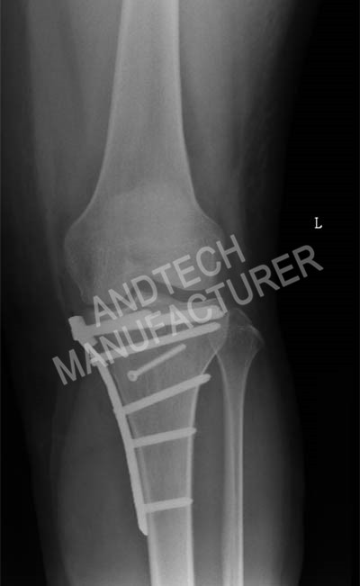 Proksimal-Tibia4