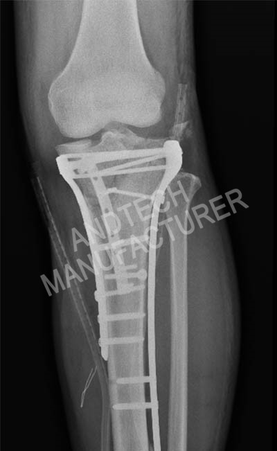 Proximal-Tibia ၅