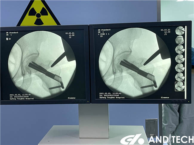 Aseyori Iṣakoso ti Femoral Ọrun Fractures pẹlu ATI FNS3