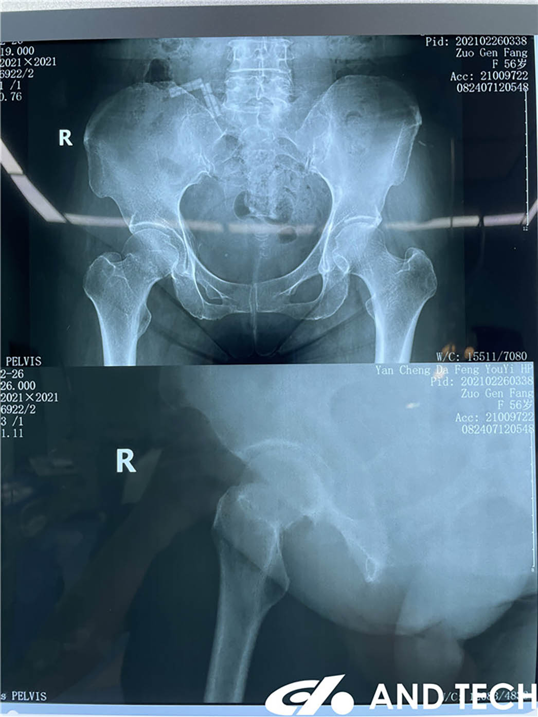 Prosperum Procuratio Fracturae Colli Femoralis cum ET FNS5