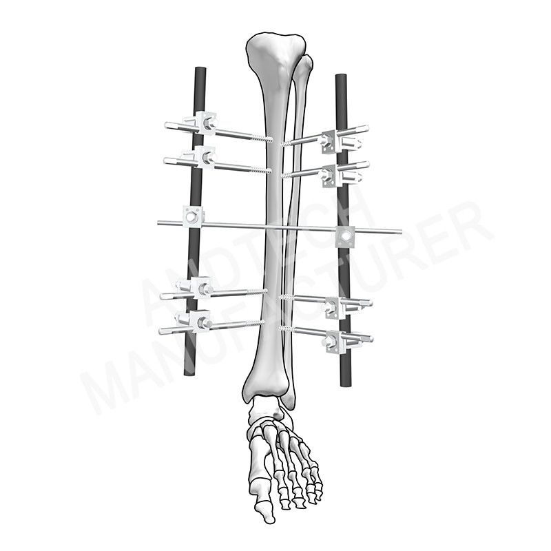 Tibia-Fixation-11mm