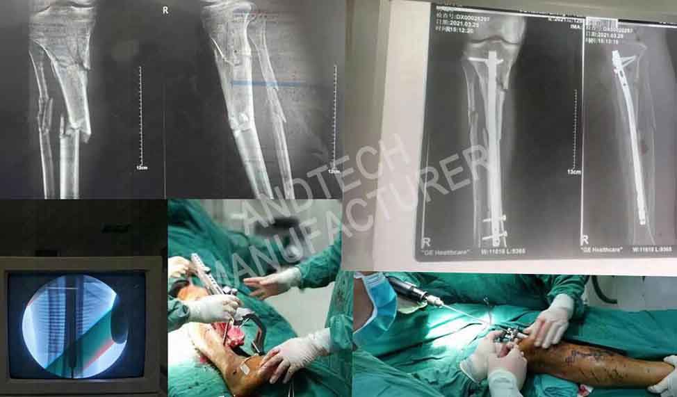 Tibia Intramedullary Nail System case