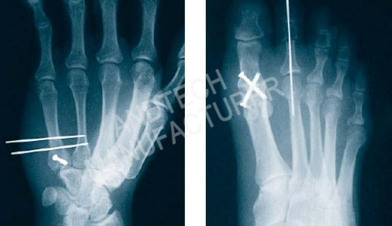Titanium-Cannulated-Bone-Screw1