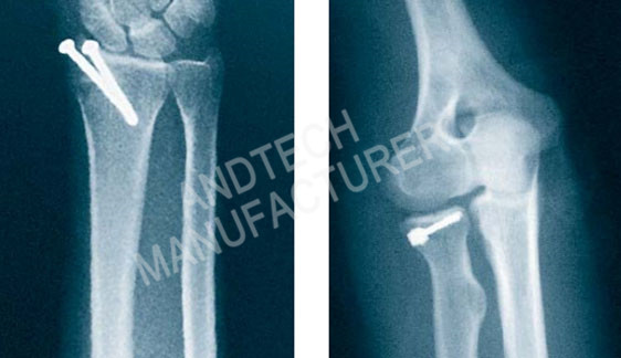 Titanium-Cannulated-Bone-Screw2