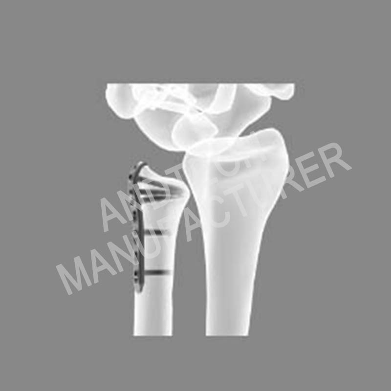 Ulnar-styloid-locking-plate01