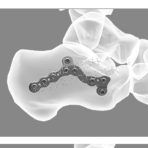 结合型跟骨锁定板细节图1(1)
