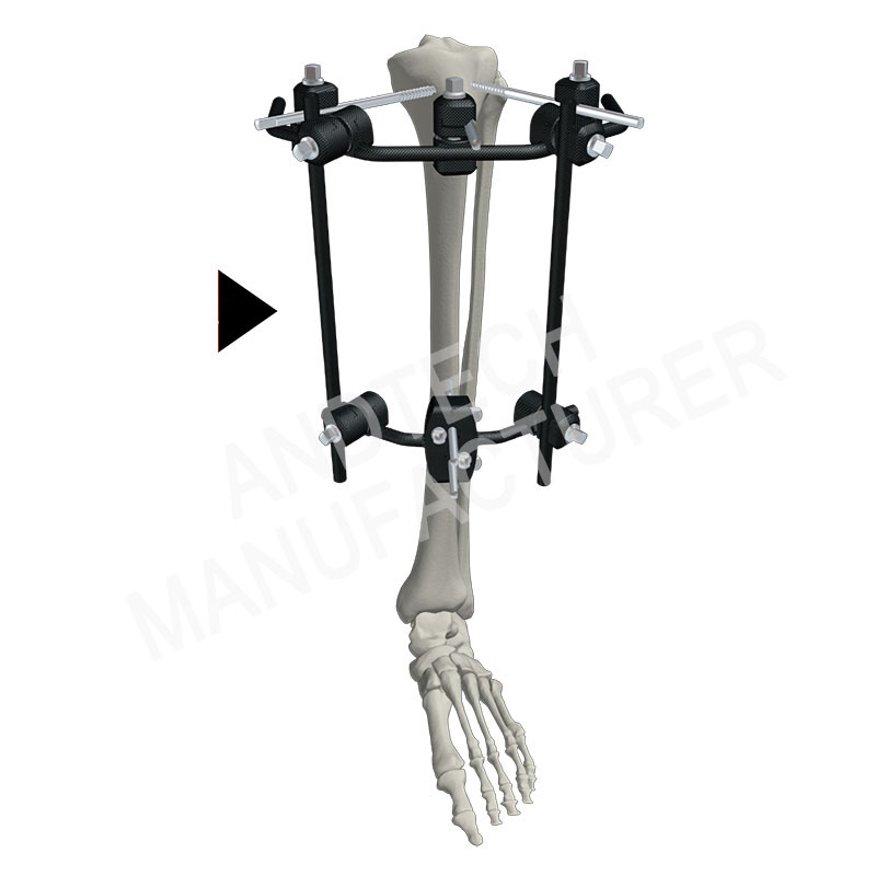 ڪاربان-فائبر- proximal- tibia-fixation-8mm