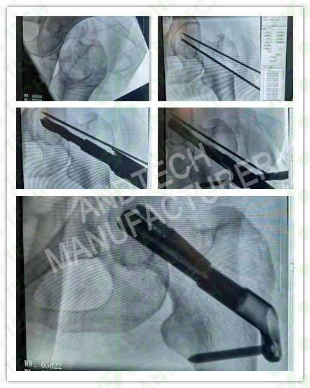 FNS-Femoral-Neck-System-case