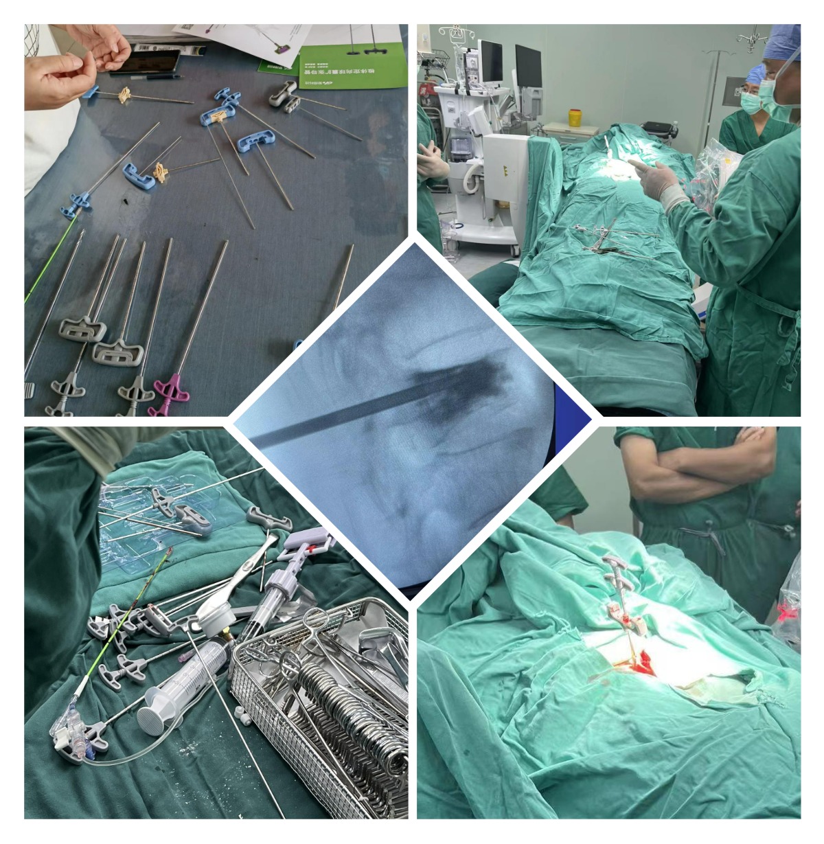 Training, Discussion, Surgery guidance of Kyphhoplasty System